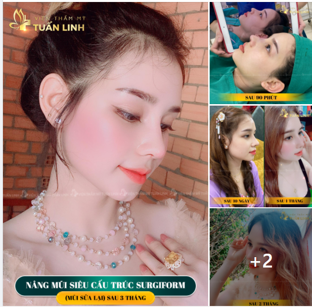 HÀNH TRÌNH NÂNG MŨI SIÊU CẤU TRÚC CỦA CÔ NÀNG 9X