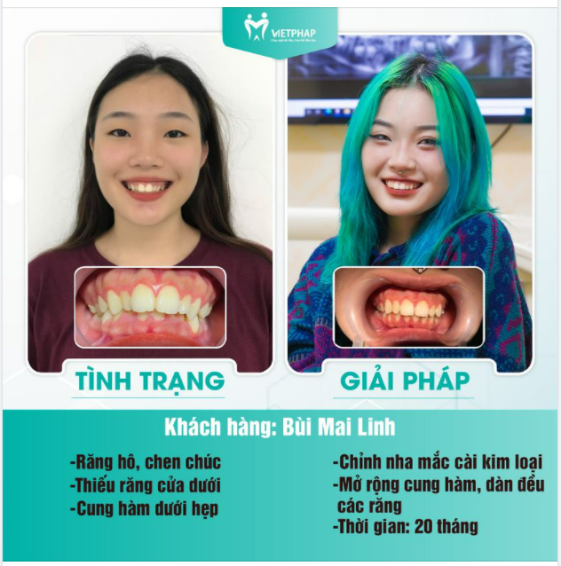 Hầu hết mọi người đều cảm thấy niềng răng rất là xấu, rất tự ti nhưng đối với em thì niềng răng giúp em trở nên nổi bật hơn hẳn