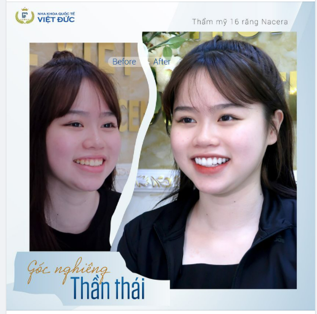 HẾT HÔ, HẾT CƯỜI HỞ LỢI VỚI THẨM MỸ RĂNG SỨ NACERA