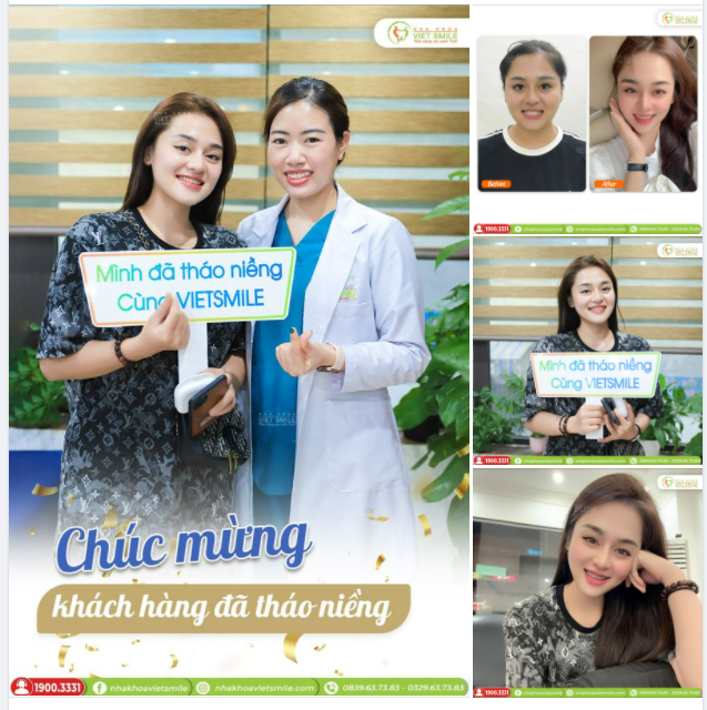 HẾT KHỚP CẮN NGƯỢC, NỤ CƯỜI RẠNG RỠ SAU GẦN 2 NĂM NIỀNG