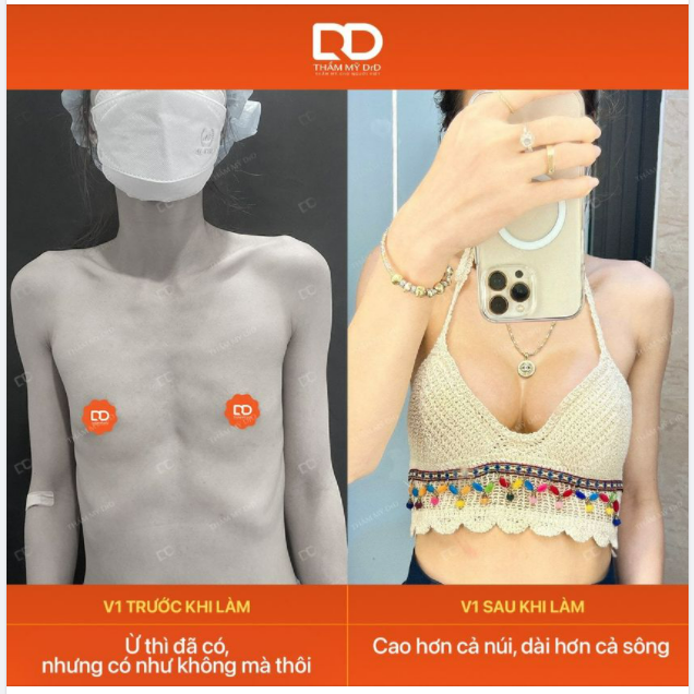 Hình ảnh của tôi trước và sau khi nâng V1 kiểu