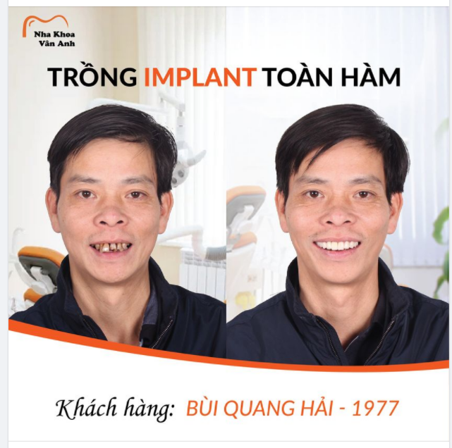 HÔ BIẾN NỤ CƯỜI TRỞ VỀ THỜI THANH XUÂN, CHÚ HẢI PHẤN KHỞI VUI MỪNG