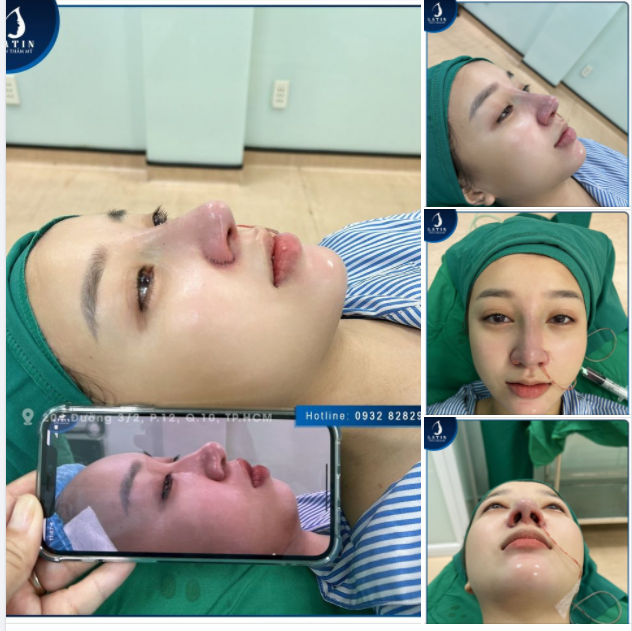 Hồi đó cứ tưởng sẽ chẳng bao giờ nâng mũi đâu, vì em cũng nhát ghê lắm, trung thành với mũi tẹt cũng 20 mấy năm.