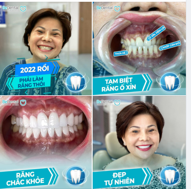 Hơn 30 năm chung sống với hàm răng ố vàng và câu chuyện phía sau