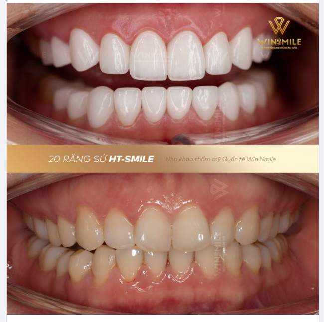 HT Smile - XUA TAN  RĂNG CÁNH BƯỚM”, CÂN ĐỐI HÌNH THỂ SẮC NÉT TRÊN TỪNG CHI TIẾT