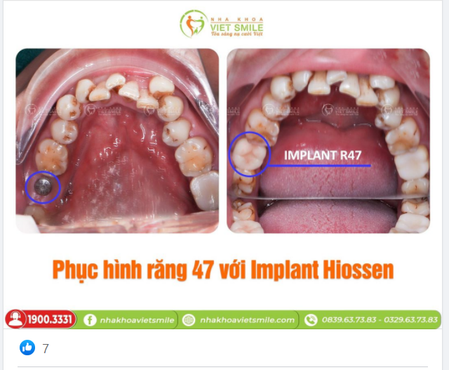 IMPLANT HIOSSEN - PHỤC HÌNH THÀNH CÔNG R47