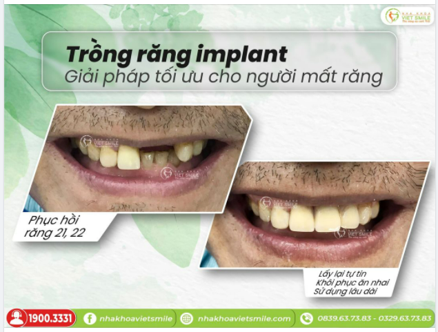 IMPLANT PHỤC HÌNH RĂNG 21,22 - LẤY LẠI TỰ TIN, CẢI THIỆN ĂN NHAI