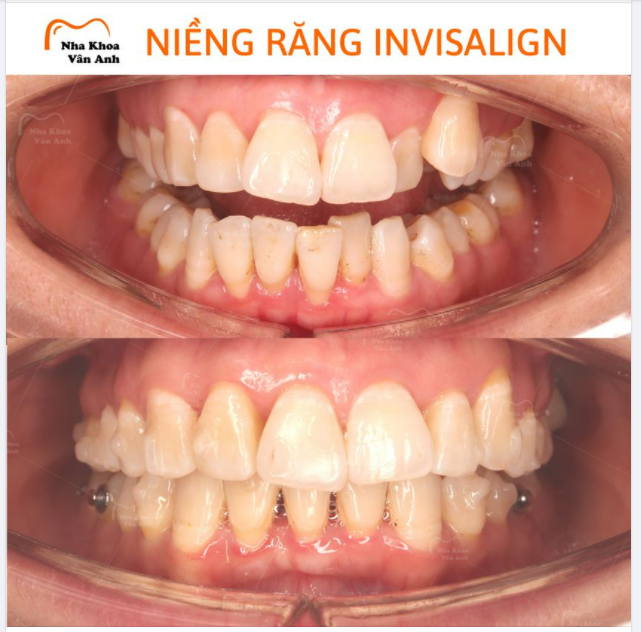 INVISALIGN ĐIỀU TRỊ HÀM HÔ, KHẤP KHỂNH “NHẸ NHƯ MÂY”