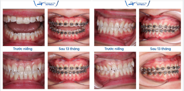 KHẮC PHỤC HOÀN TOÀN TÌNH TRẠNG RĂNG MÓM BẰNG CÔNG NGHỆ X - MATRIX
