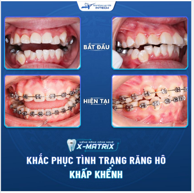 KHẮC PHỤC TÌNH TRẠNG RĂNG HÔ, KHẤP KHỂNH NHỜ NIỀNG RĂNG X - MATRIX