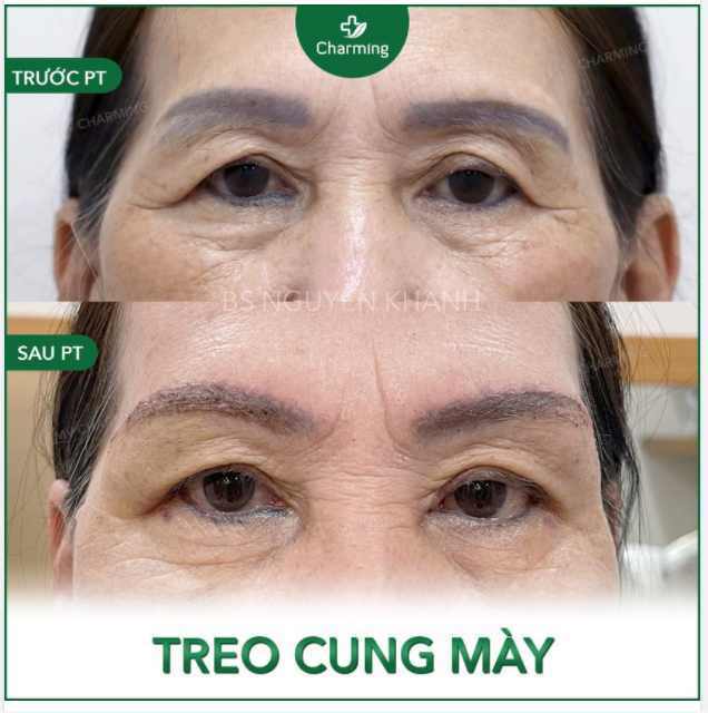 Khi đã qua tuổi trung niên, đâu hiệu của tuổi tác cũng sẽ kéo đến đậu trên gương mặt của bạn. Và nơi đầu tiên dễ xuất hiện dấu hiệu của thời gian nhất là vùng quanh mắt, vùng chân mày.