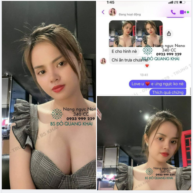 KHOE LIỀN TAY FEEDBACK NÂNG NGỰC NANO 340 CC