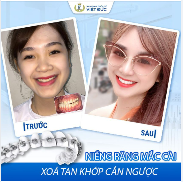 KHÔNG CÒN KHỚP CẮN NGƯỢC - TỰ TIN CƯỜI TỎA SÁNG