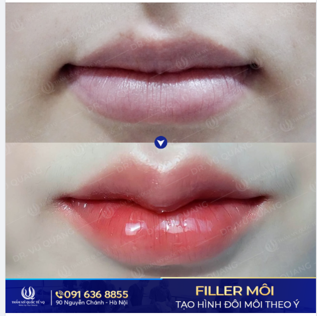 Không phải cứ tiêm filler là sẽ biến chứng, gặp nguy hiểm.