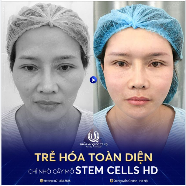 Khuôn mặt hốc hác, kém tươi tắn là nguyên nhân khiến bạn lúc nào cũng ủ dột, mệt mỏi, già hơn tuổi, da xạm đen, thiếu tự tin trong giao tiếp.