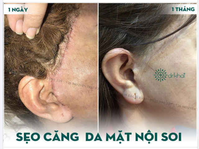 KỸ THUẬT CĂNG DA ĐỘC QUYỀN - KHÔNG ĐỂ LẠI SẸO