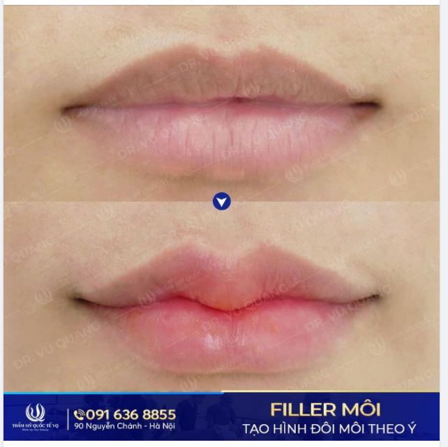 Làm đẹp bằng Filler - Bạn nhất định phải biết
