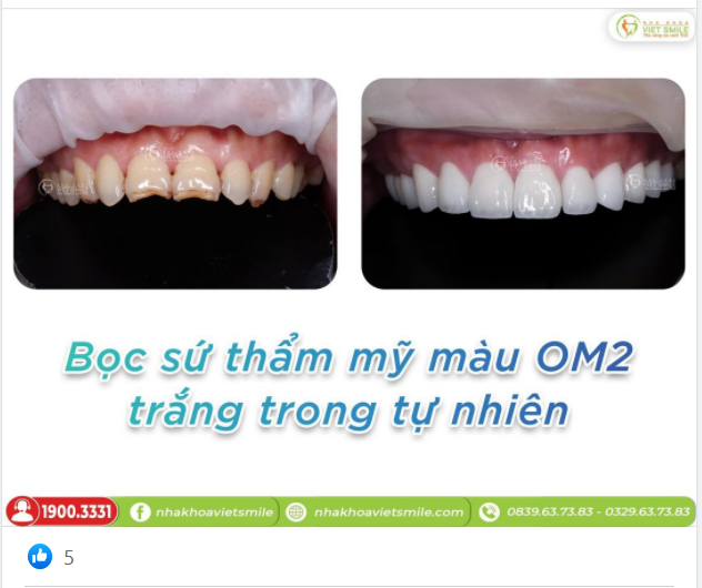 Làm răng sứ tại VIETSMILE xong nhìn răng cũ chị không nhận ra luôn. Nhìn màu tự nhiên, quá trình cũng nhẹ nhàng"