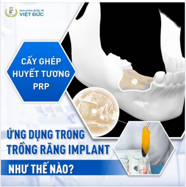 LÀNH THƯƠNG NHANH GẤP 5 LẦN NHỜ ỨNG DỤNG PRF TRONG CẤY GHÉP RĂNG IMPLANT