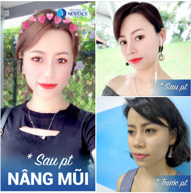 “LÃO HÓA NGƯỢC” SAU 3 NĂM NHỜ…NÂNG MŨI CẤU TRÚC