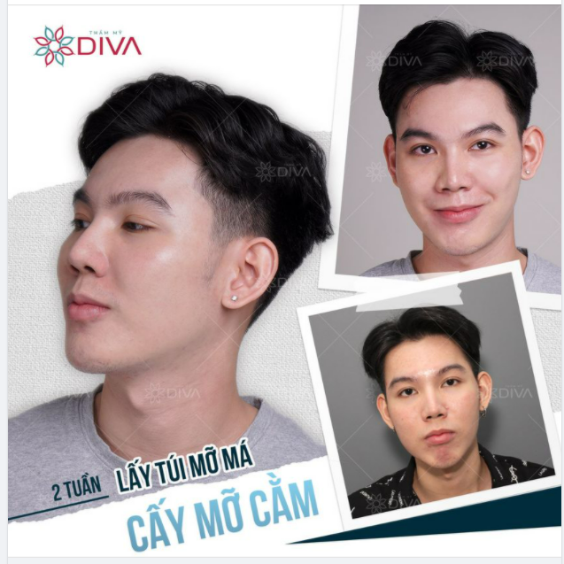 LẤY TÚI MỠ MÁ, CẤY MỠ CẰM SIÊU PHẨM SAU 10 NGÀY THẨM MỸ
