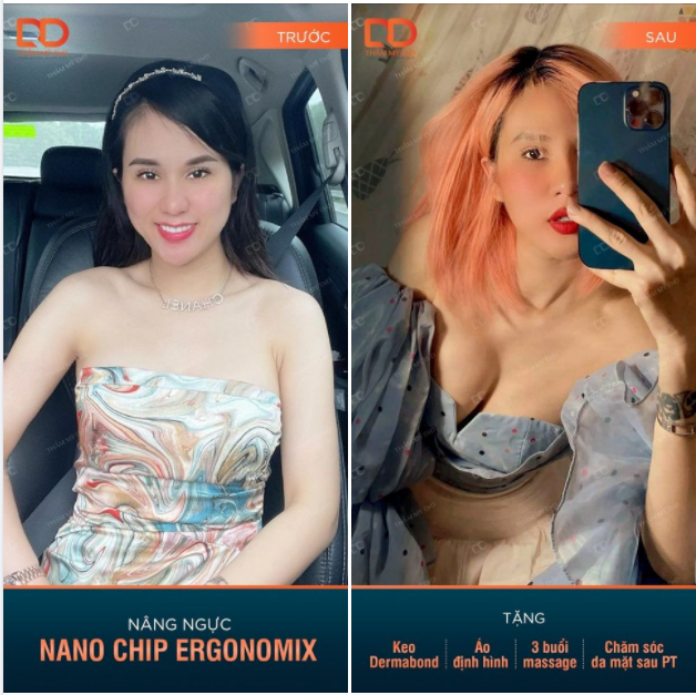 Lo Nâng Ngực Đắt Nàng chỉ cần muốn, còn mọi thứ để DrD lo.