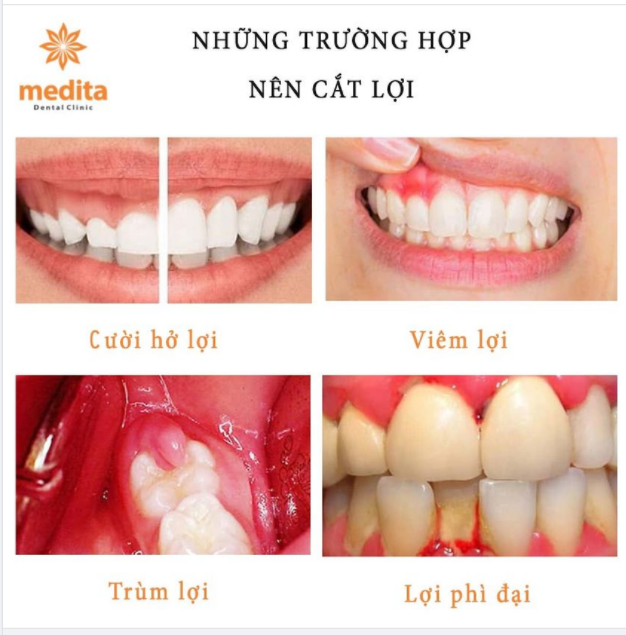 LỢI NHƯ THẾ NÀO THÌ NÊN CẮT