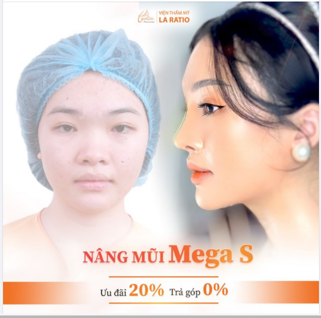 LỘT XÁC THÀNH HOT GIRL SAU 1 TUẦN NÂNG MŨI MEGA S