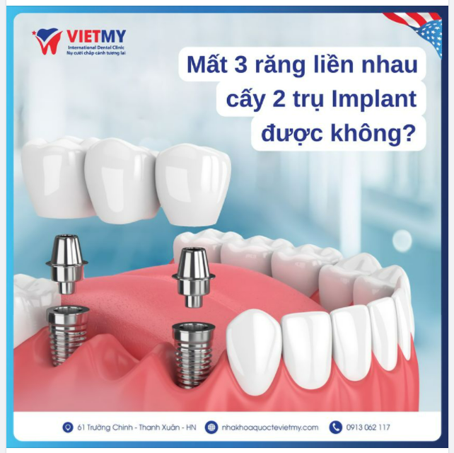 Mất 3 răng liền nhau cấy 2 trụ Implant được không