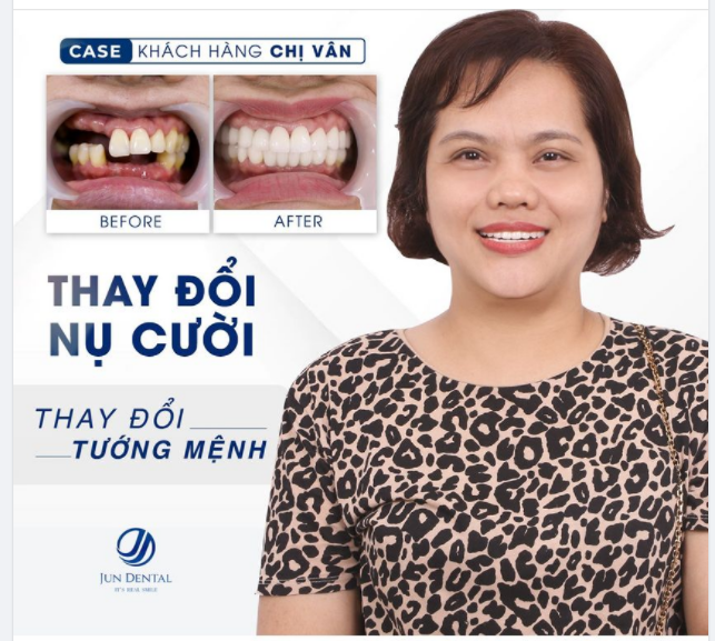 MẤT RĂNG - MẤT CÂN BẰNG ĐỦ THỨ TRONG CUỘC SỐNG!