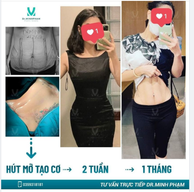 MẸ SỀ VỀ DÁNG THON VỚI BIONANO - CÔNG NGHỆ HÚT MỠ SÓNG SIÊU ÂM HỘI TỤ