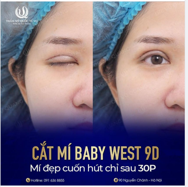 Mí Baby West 9D - Đẹp hoàn hảo từng milimet