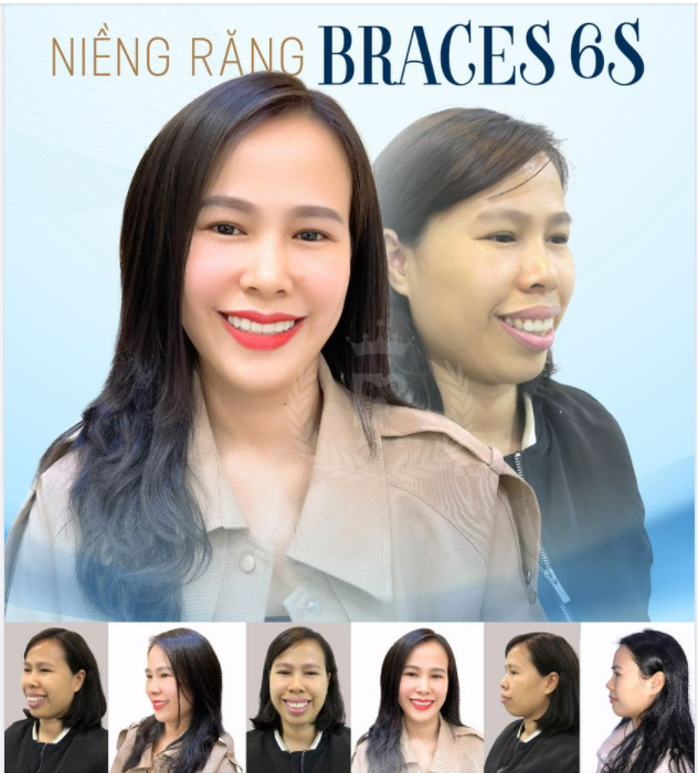 MÌNH KHÔNG PHẪU THUẬT THẨM MỸ ĐÂU, CHỈ LÀ NIỀNG RĂNG THÔI MÀ