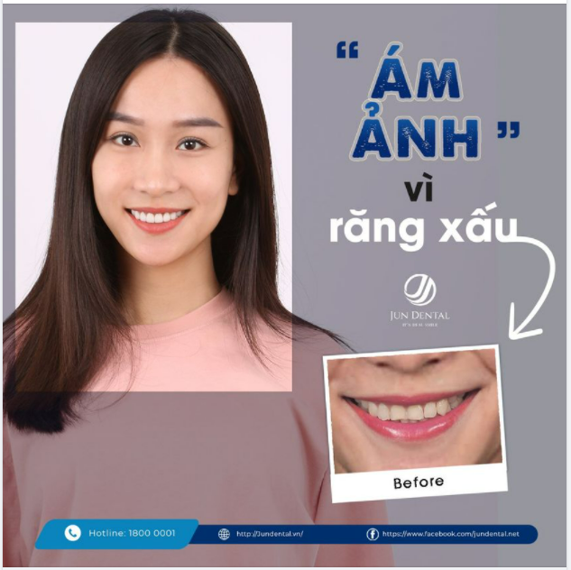Mình từng bị ám ảnh vì răng xấu Đây là lời chia sẻ của Khách hàng HOÀNG BẢO ANH khi tìm đến Jun Dental.