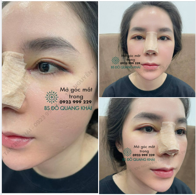 MỞ GÓC MẮT TRONG - LÒNG MẮT SÂU, HÚT ÁNH NHÌN