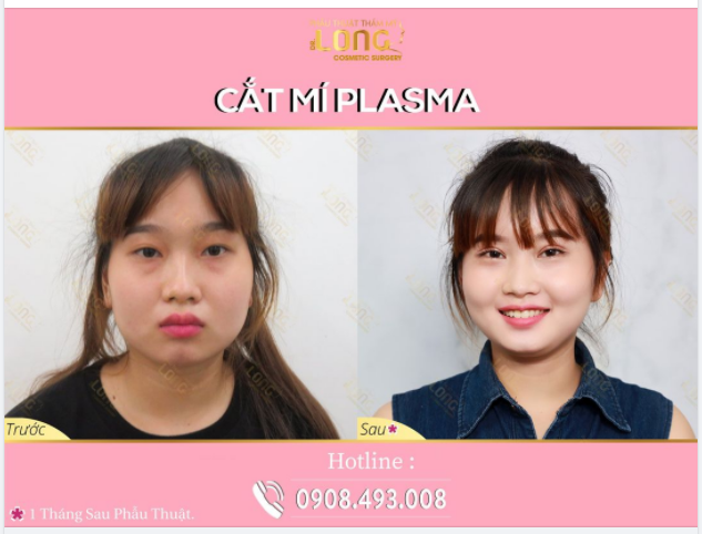 Một chiếc mí xinh sẽ giúp bạn có được một đôi mắt long lanh có hồn