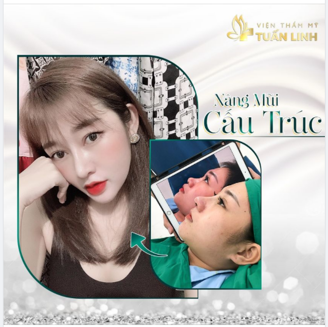 Một chiếc mũi cấu trúc xinh đẹp nhà Tuấn Linh sau 1 năm phẫu thuật 