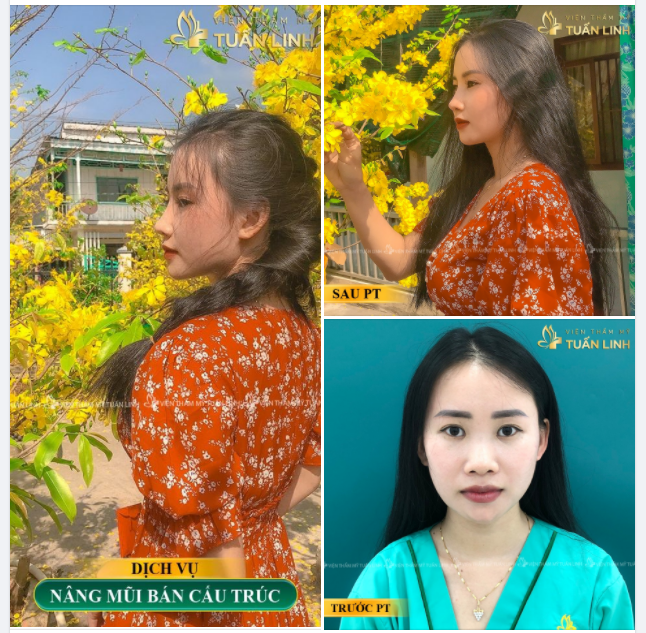 MỘT CHIẾC MŨI XINH ĐÃ NÂNG TẠI TUẤN LINH.