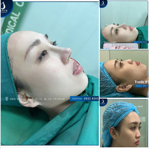 Một chiếc mũi xinh vừa mới ra lò Ekip bác sỹ Latin làm chuẩn chỉnh, an toàn.