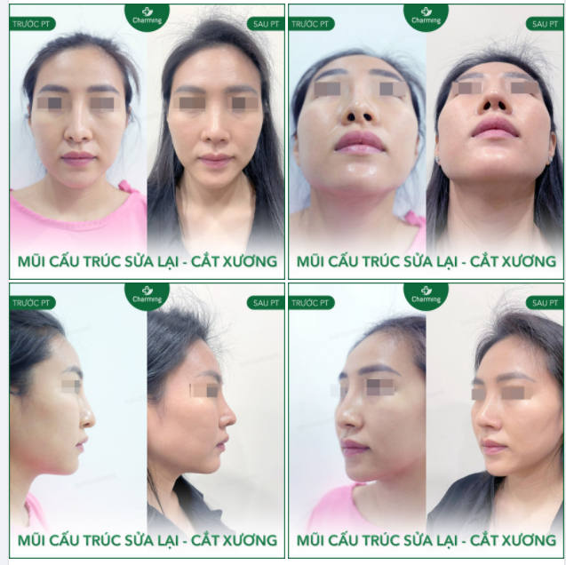 Một pha mũi sửa lại siêu tự nhiên bằng phương pháp nâng mũi cấu trúc sụn sườn và cắt xương out trình luôn chiếc mũi cũ không thấy sóng mũi, lệch và lộ sóng.