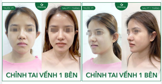 Một tai vểnh, một tai bình thường sẽ khiến nhiều người dễ cảm thấy tự ti và bất mãn với đôi tai của mình hơn.