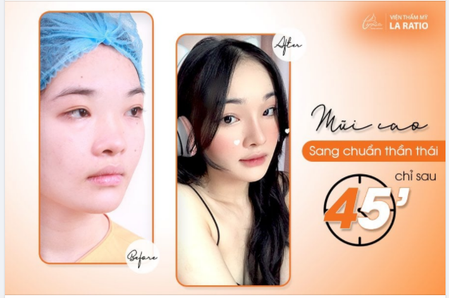 MŨI CAO SANG CHUẨN THẦN THÁI ƯU ĐÃI 20%