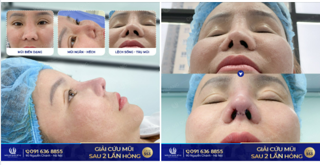 Mũi hỏng nặng sau khi làm tại Hàn Quốc