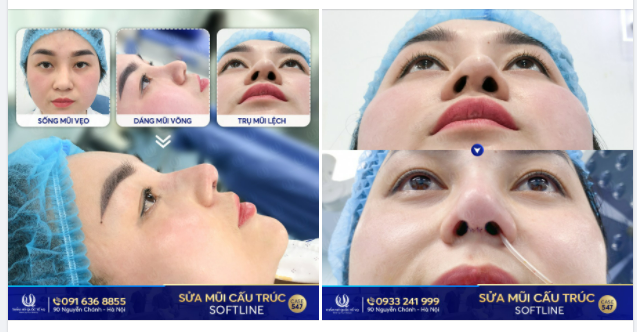Mũi lệch sau nâng - Sửa lại có lệch thêm lần nữa