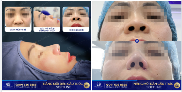 MŨI THẤP, HẾCH, BÈ, KHÔNG CÂN ĐỐI THAY ĐỔI thế nào sau Nâng mũi bán cấu trúc Softline
