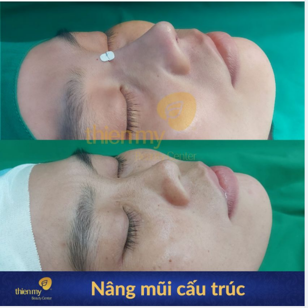 Mũi thiếu sống mũi, to bè thì cần phải xử lý như thế nào!