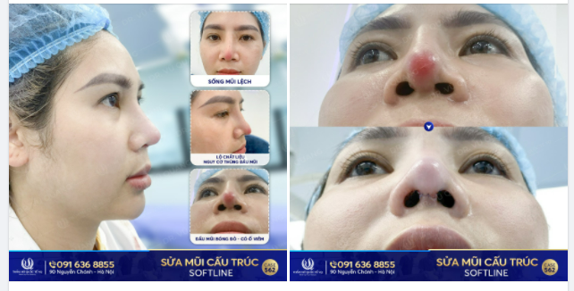 Mũi viêm nhiễm bóng đỏ, mũi lệch sống, lộ chất liệu, có nguy cơ thủng đầu mũi - Dr Vũ Quang sửa lại, Đẹp xuất sắc .