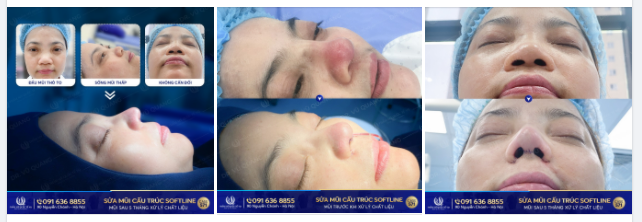 Mũi viêm nhiễm nặng, sưng mủ - Sửa lại như thế nào