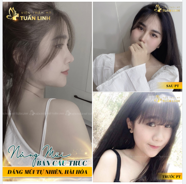 Muốn bản thân tự tin,xinh đẹp hơn chọn ngay nâng mũi tại Tuấn LInh