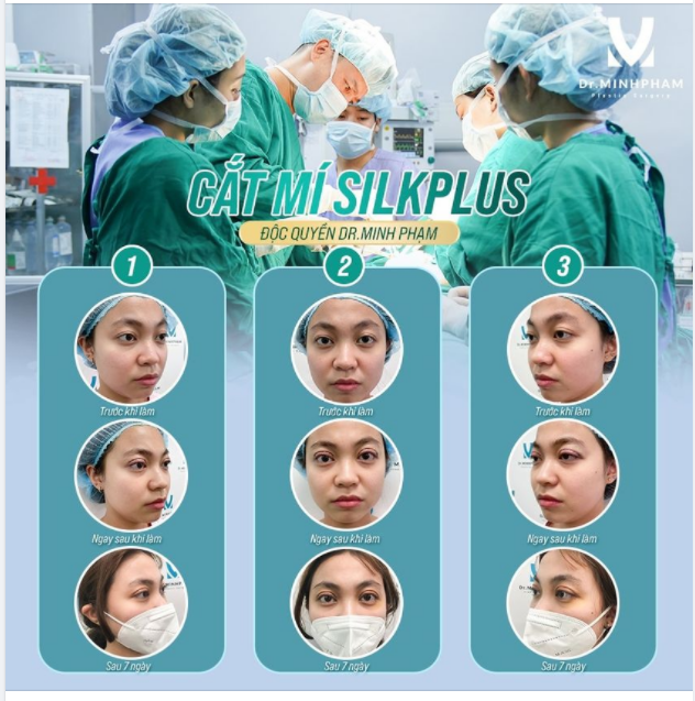 MUỐN CẮT MÍ KHÔNG SƯNG, KHÔNG SẸO VỀ NGAY TEAM DR.MINH PHẠM